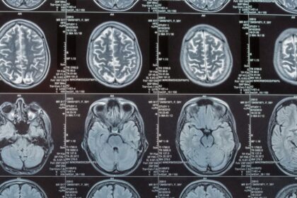 Scientists Say a Key Trigger for Alzheimer’s Damage Isn’t Even in the Brain