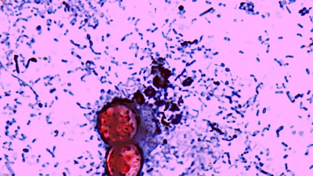 The Explosive Diarrhea Outbreak Has Turned Deadly