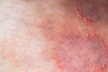A Drug-Resistant Ringworm Fungus is Surging Across the Globe, Scientists Warn