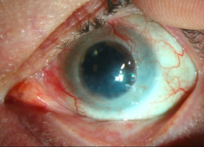 6. After Photo Of Cornea Post Calec